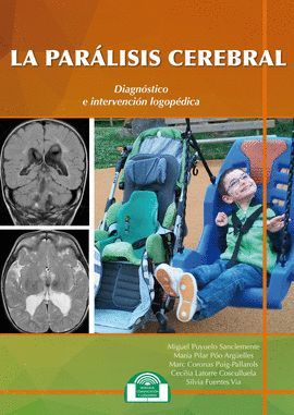 PARÁLISIS CEREBRAL, LA